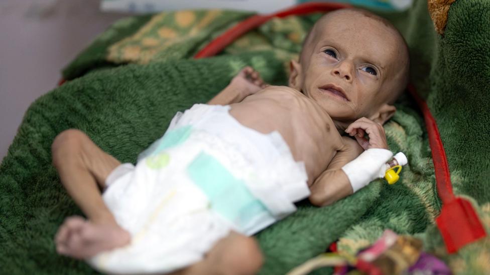 Oziqlanish yetishmasligidan azob chekayotgan Raad Hassan, Yamanning Aden shahridagi kasalxonada