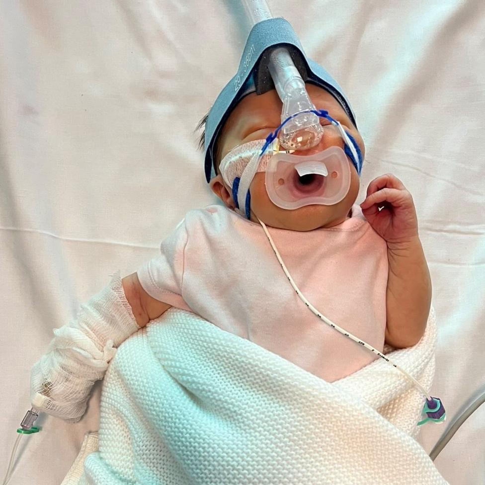 Florence is a newborn baby girl who is seen lying in a hospital baby crib. Her left arm is bandaged and a CPAP machine is placed over her mouth and nose. Her eyes are closed and her right hand is raised.