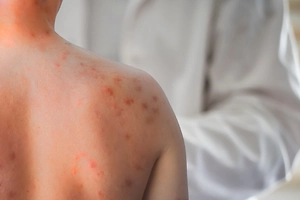 Why are measles and Haemophilus influenzae infection cases rising, and what do vaccination coverage and bloggers have to do with it: a doctor answers