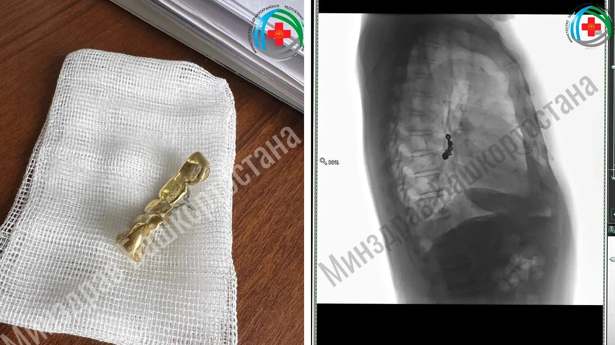 A man carried a denture with five gold teeth in his bronchus for two years. Photo © Telegram / Airat Rakhmatullin